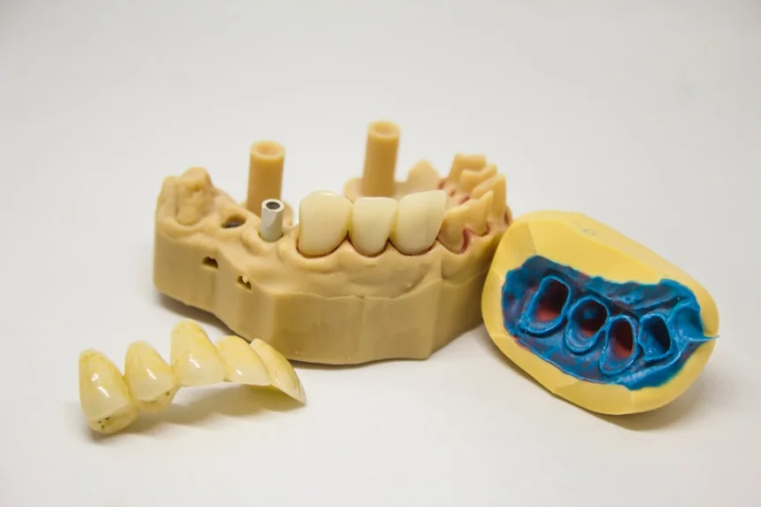 Wisdom tooth